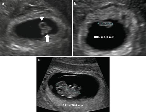 Normal First Trimester Of Pregnancy First Trimester Ultrasound A