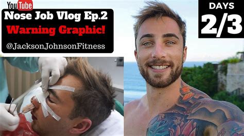Nose Job Vlog Ep2 Warning Graphic And Emotional Day 23 Jackson