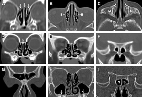 Normal Anatomy And Anatomic Variants Of The Paranasal Sinuses On