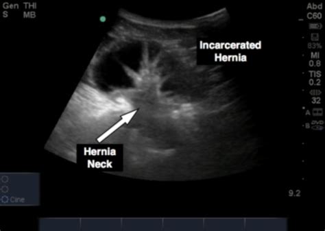 Point Of Care Ultrasound For Hernias —
