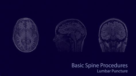 Basic Neuroradiology Procedures Part 2 Lumbar Puncture Youtube