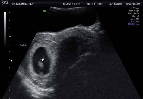 Corpus Luteum Cyst October 2019 Babies Forums What To Expect