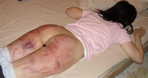 Pictures Showing For Extreme Spanking Bruise Mypornarchive Net