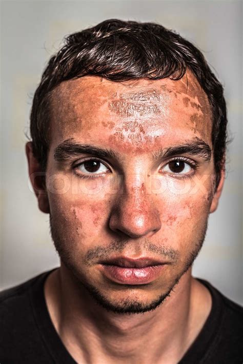 Sunburn Skin On Male Face Stock Image Colourbox