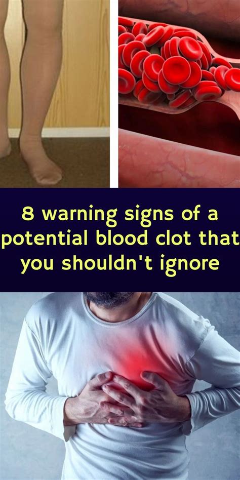 8 Warning Signs Of A Potential Blood Clot That You Shouldn T Ignore