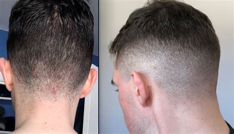 Before&After Azelaic Acid cleared up my scalp Acne ...