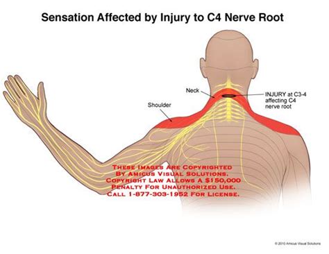 Normal anatomy, variants and checklist. amicus,medical,injury,c4,nerve,root,sensation,affected ...