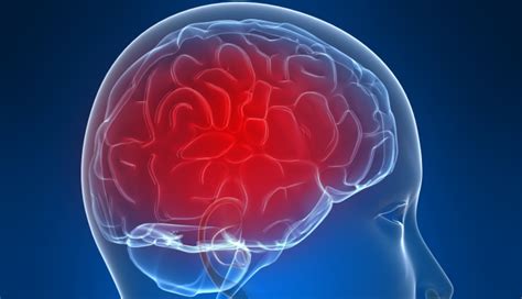 Inflammation In Brain Linked To Schizophrenia