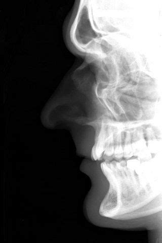 It is situated at the roof of the nasal cavity, and between the two orbital cavities. xray...nasal bones | Facial bones, Medical radiography, X ray