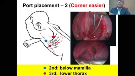 Martin Lacher Thoracoscopic Repair Of Congenital Diaphragmatic Hernia