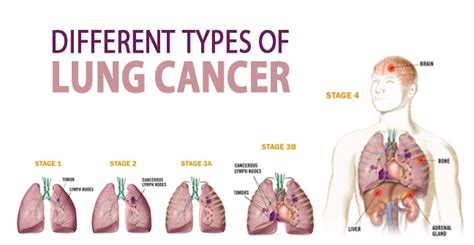 types of lung cancer tumors
