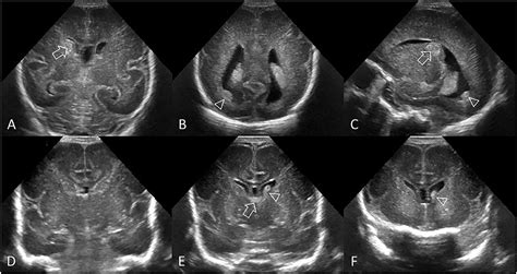 Intraventricular Hemorrhage Ultrasound