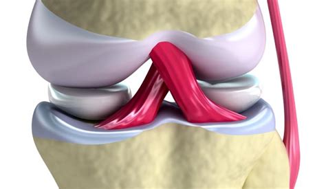 Rupture du ligament croisé antérieur LCA Index Santé