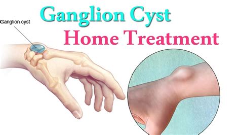 What To Do When A Ganglion Cyst Ruptures Robert Marti Vrogue Co
