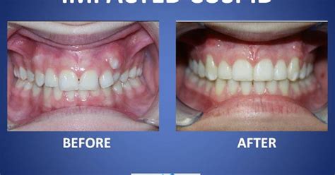 Braces Before And After Impacted Cuspid Braces Before And After