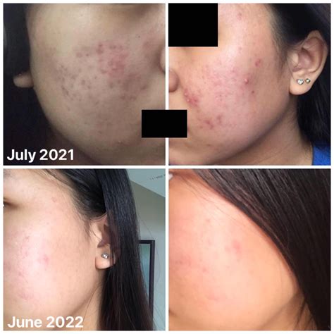 Banda My 1 Year Acne Progression Using A Proper Skincare Routine R