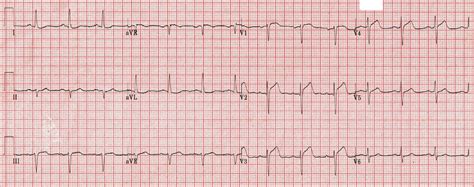Ecg of st elevation myocardial infarction stemi vector image these pictures of this page are about:stemi vs nstemi ecg. Dr. Smith's ECG Blog: A Missed STEMI. How could the ...