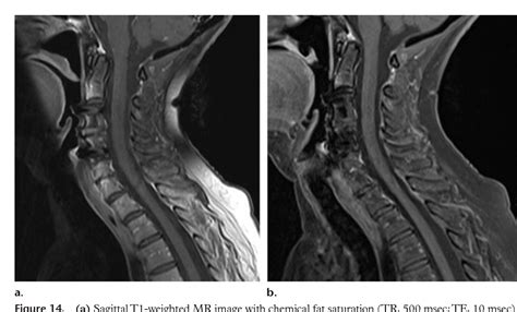 Fat Suppression Techniques For 3 T Mr Imaging Of The Musculoskeletal