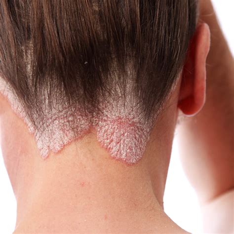 Psoriasis And Hair Loss Causes Symtoms And Treatment Advice Hillside