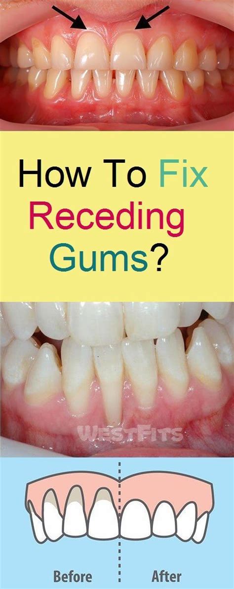 How To Fix Receding Gums Receding Gums Gum Care Gum Recession