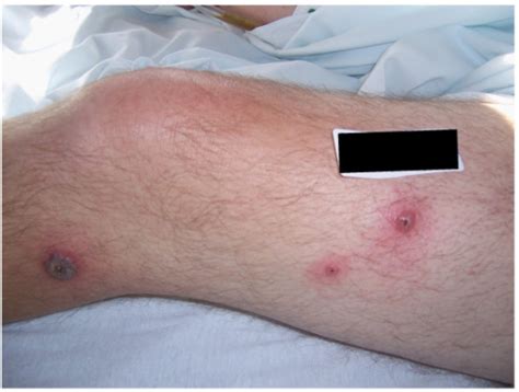Figure 1sweets Syndrome In A Patient With Crohns Disease A Case
