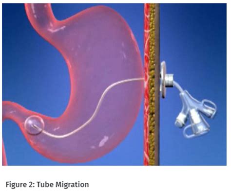 Gastrostomy Transgastricjejunal Jejunal Tube Care