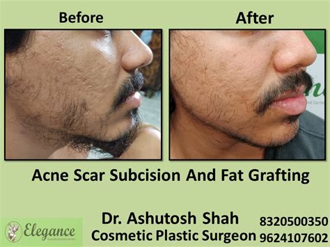 Acne Scar Subcision Fat Grafting Treatment Acne Removal In Adajan Surat