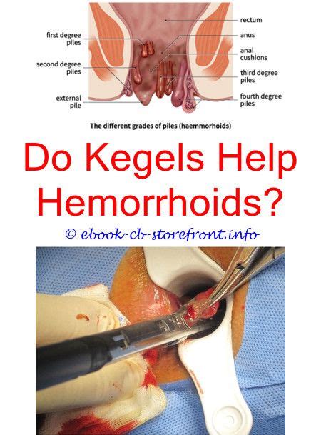 Acutely tender, thrombosed external hemorrhoids can be surgically removed if. 10+ Fantastic Internal Hemorrhoid Health Ideas
