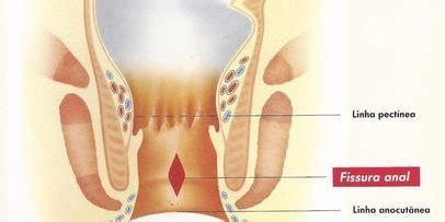 Fissura Anal Flashcards Quizlet