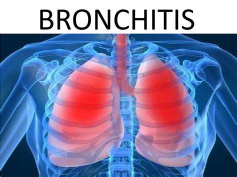 Ppt Bronchitis Powerpoint Presentation Free Download Id1857430