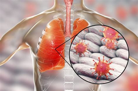 Viral Testing May Reduce Antibiotic Use In Severe Lower Respiratory