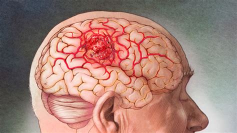 Edema Cerebral Causas Síntomas y Tratamiento