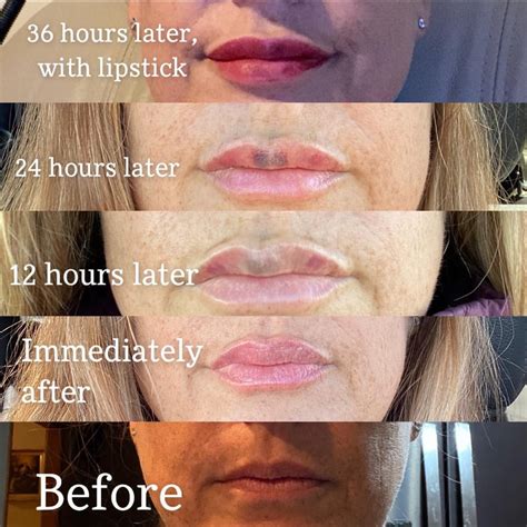 Juvederm Lip Injections Over 36 Hours Plasticsurgery