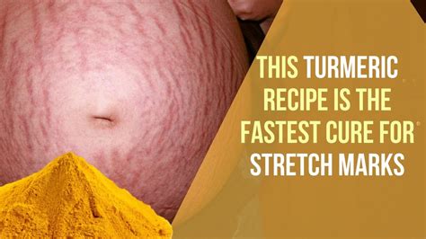 This Turmeric Recipe Is The Fastest Cure For Stretch Marks Youtube