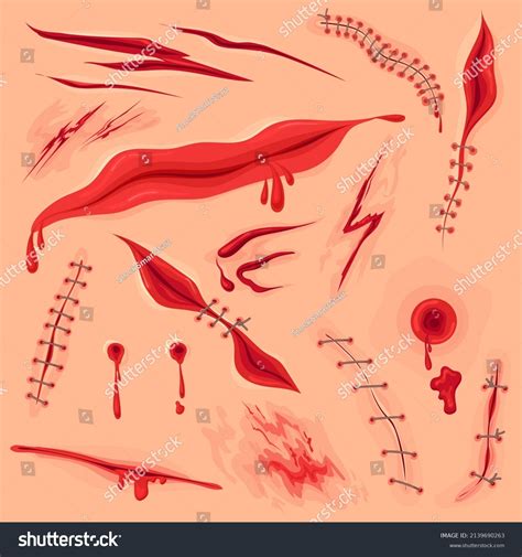 Skin Incision Wound Bloody Surgery Stitch Stock Vector Royalty Free