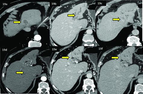 Cect Triple Phase Study Of The Liver Diagnosed As Cholangiocarcinoma