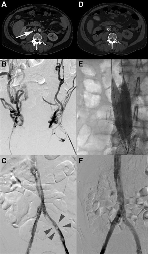 Iliocaval Reconstruction Of Chronically Thrombosed Cylindrical Inferior
