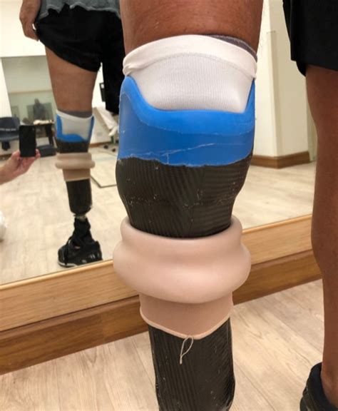 A New Below Knee Prosthetic Socket Design By Bengt Soderberg CPO At CEPO