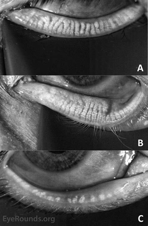 Current Concepts In The Diagnosis And Management Of Meibomian Gland
