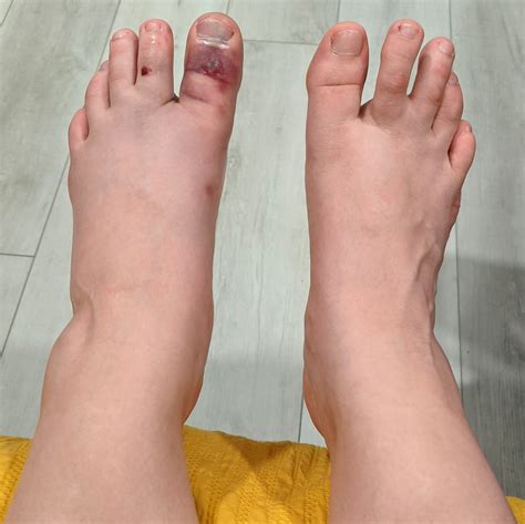 Traditional Chinese Medicine Case Report Broken Big Toe — Alina Rehkopf