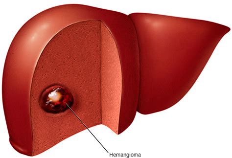 Hemangioma Hemangioma Of Skin Spine Liver Causes And Treatment