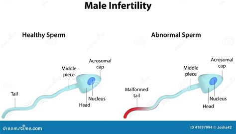 Male Infertility Stock Vector Image 41897994