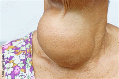 Woman With Enlarged Hyperthyroid Gland Hyperthyroidism Symbol