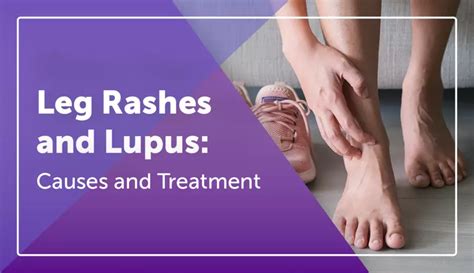 Leg Rashes And Lupus Causes And Treatment Mylupusteam