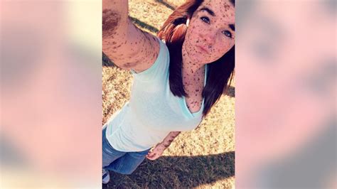 19 Year Old Born With Body Covered In Birthmarks Is ‘proud To Be