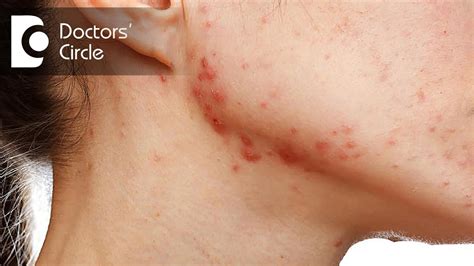 What Causes Acne Scarring Keloids And Recurring Cysts On Body Dr