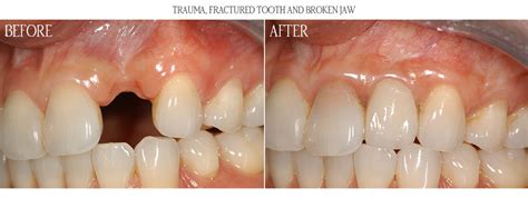 Before And After Gallery Asird American Society Of Implant And