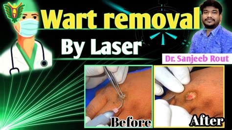 Wart Removal By Laser Dr Sanjeeb Rout Youtube