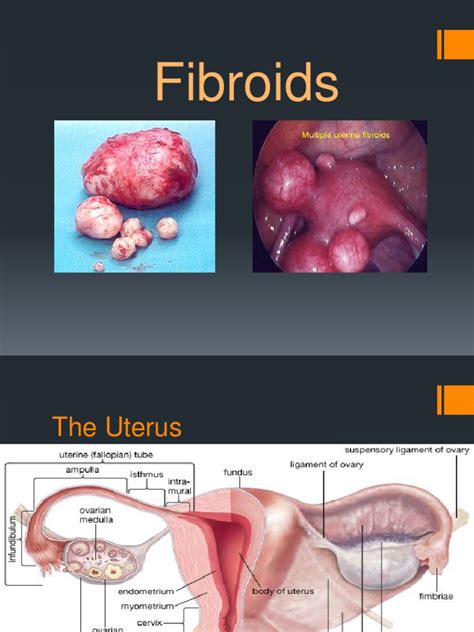 Fibroids Powerpoint Pdf Uterus Sexual Anatomy