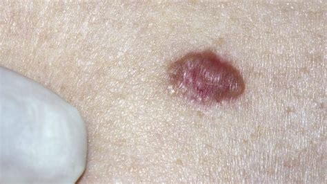 How Does Skin Cancer Start Gentlecure